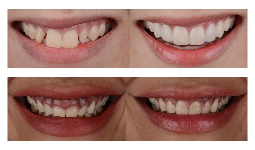 Aligner